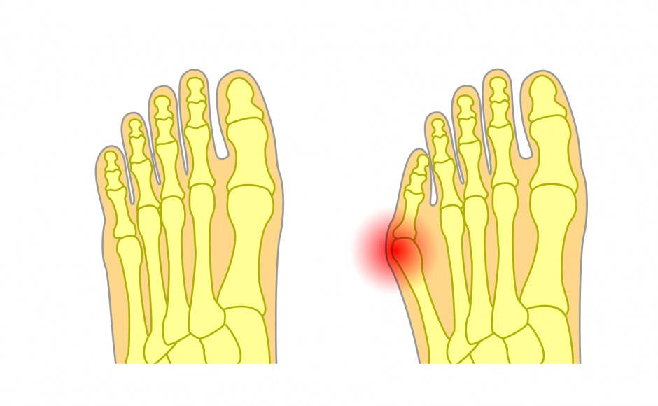 Advanced Tailor’s Bunion Surgery | YEG Foot and Ankle Inc
